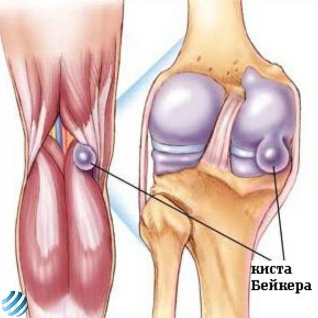 Киста бейкера лечение. Препателлярный бурсит. Ганглиевая киста коленного сустава. Заднелатеральная киста Бейкера. Киста Бейкера на УЗИ коленного сустава.