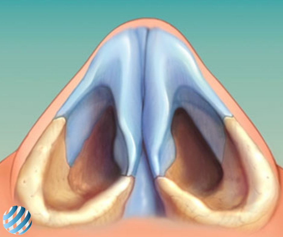 Нос снизу. Анатомия искривления перегородки носа. Хондроперихондрит носовой перегородки. Анатомия искривлённой носовой перегородки.
