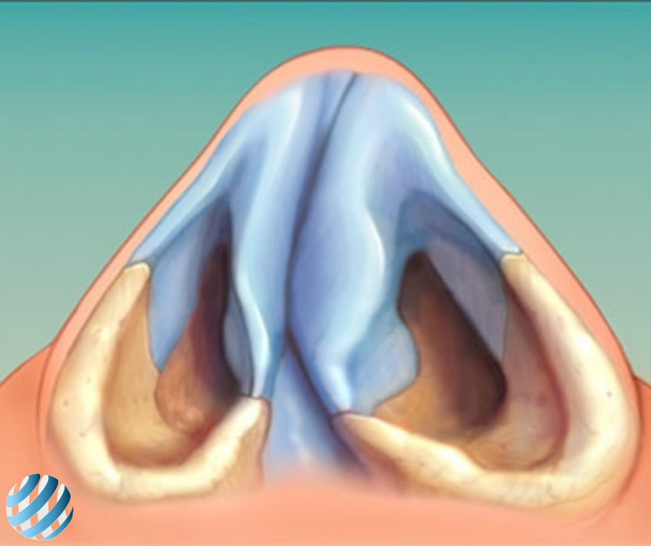 Искривление носовой перегородки: диагностика и лечение в клинике Hadassah